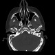Dysplasia of head of mandible, bilateral: CT - Computed tomography